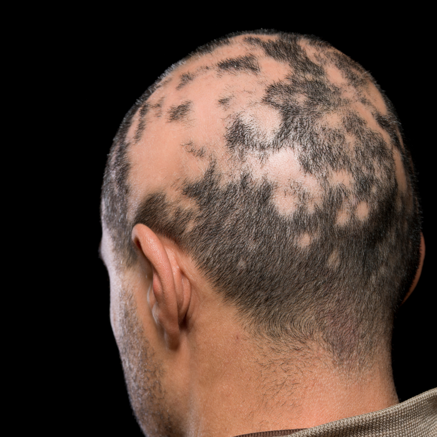 AlopeThol Integrated Follicular Protocol | Bütüncül Saç Bakım ve Destek Sistemi