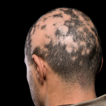 AlopeThol Integrated Follicular Protocol | Bütüncül Saç Bakım ve Destek Sistemi