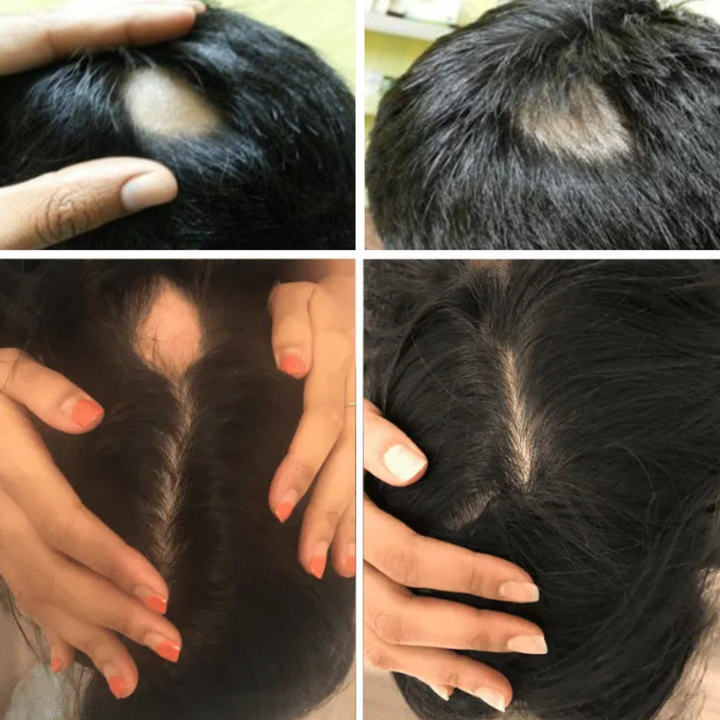 Alopesi Areata(Saçkıran) Destek Seti