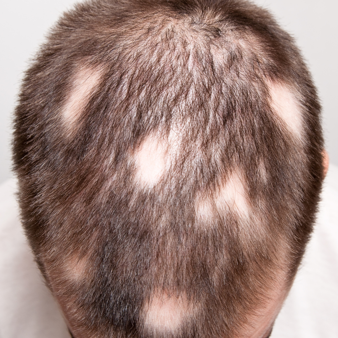 AlopeThol Integrated Follicular Protocol | Bütüncül Saç Bakım ve Destek Sistemi