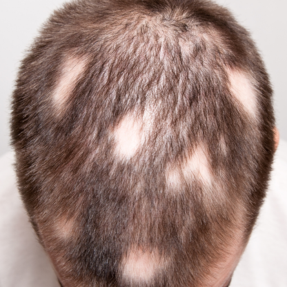 AlopeThol Integrated Follicular Protocol | Bütüncül Saç Bakım ve Destek Sistemi